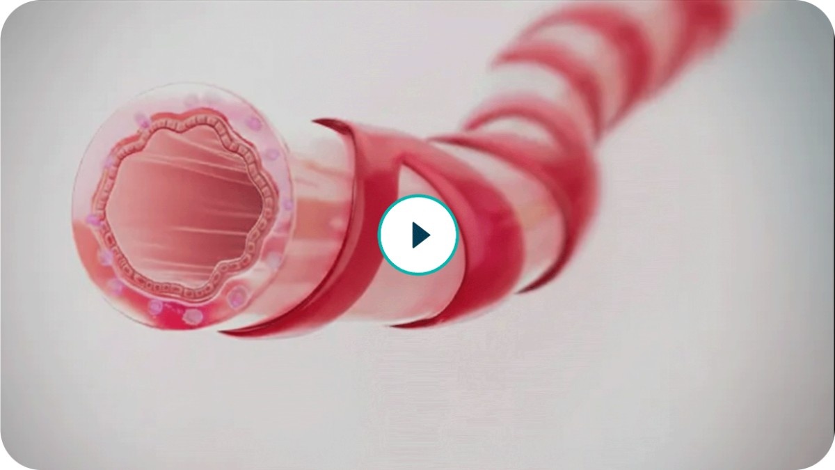 Video Illustrating Asthma Airway Inflammation and Anti-Inflammatory Rescue Concept