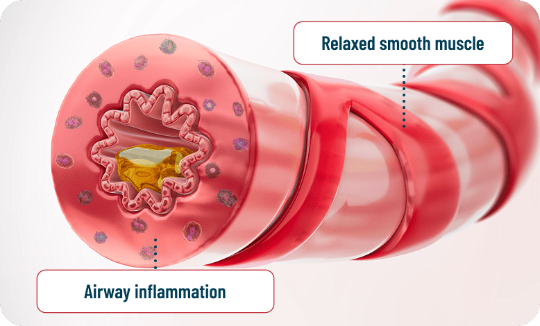 Illustration showing relaxed smooth muscle and airway inflammation, demonstrating that albuterol-only rescue treats bronchoconstriction but does not address inflammation - leaving patients at risk of exacerbations